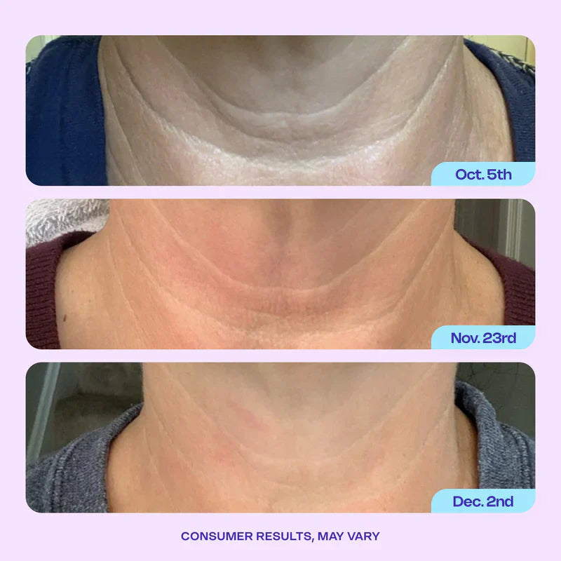 Miracle Neck Cream: Erase "Turkey Neck" & "Tech Neck" Lines Visible Lift & Smoothness in 4 Weeks