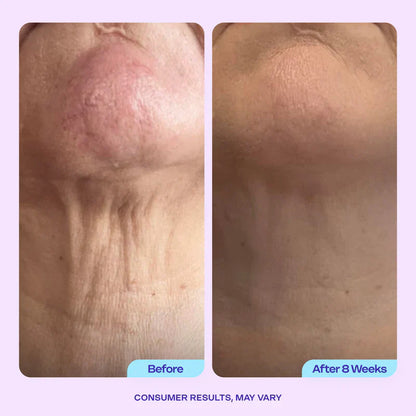 Miracle Neck Cream: Erase "Turkey Neck" & "Tech Neck" Lines Visible Lift & Smoothness in 4 Weeks