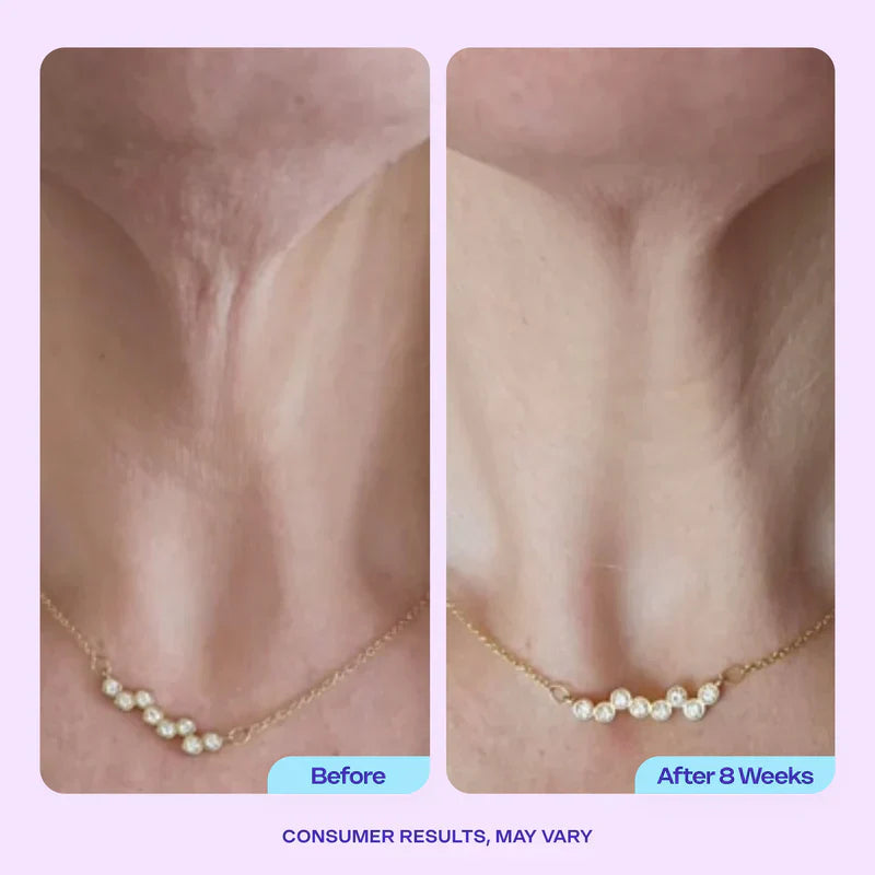Miracle Neck Cream: Erase "Turkey Neck" & "Tech Neck" Lines Visible Lift & Smoothness in 4 Weeks
