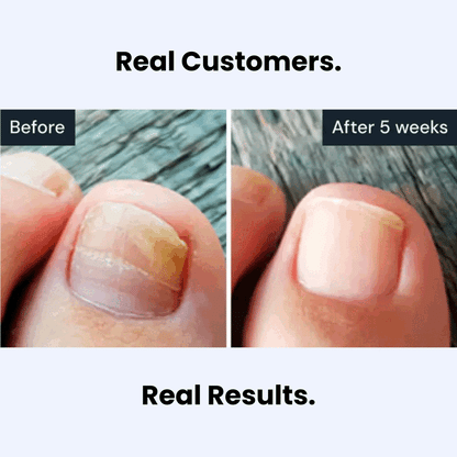 loribeaut™ Antifungal Pen